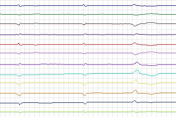 s0255lre-patient078 thumbnail