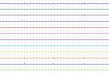s0258lre-patient077 thumbnail