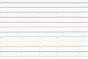 s0317lre-patient078 thumbnail